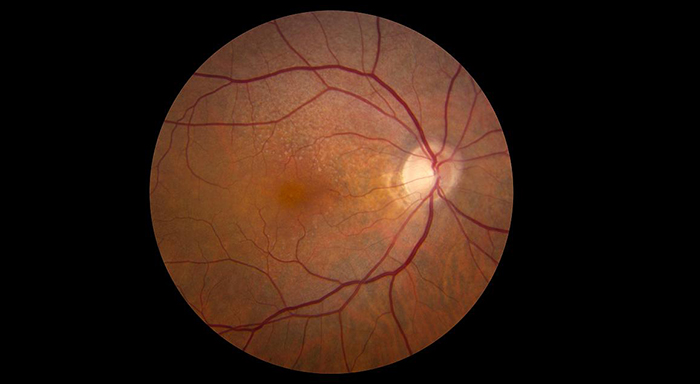 Retina showing reticular pseudodrusen